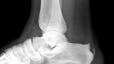 What is Heel Spur?