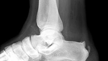 What is Heel Spur?