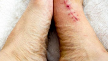 What is Bunions ? What Causes Bunions?