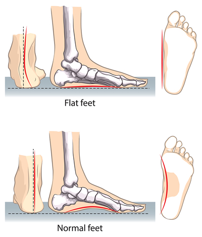 Best Shoes For Flat Feet Child | Good 