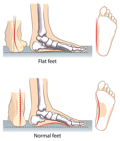 Arch Support Shoes for Flat Foot