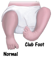 club-foot-pictures