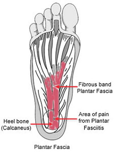 heel-spurs-plantar-fasciit