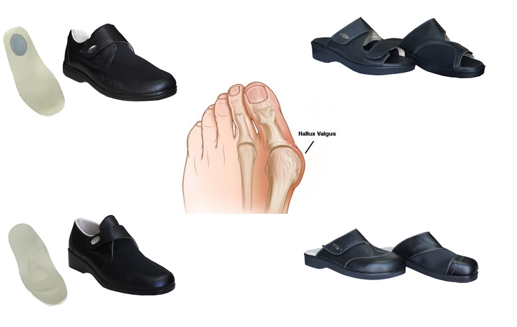 halluks-valgus-parmak-yamuklugu-terlik-ayakkabi