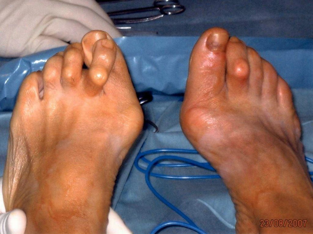 Halluks Valgus Ameliyatı